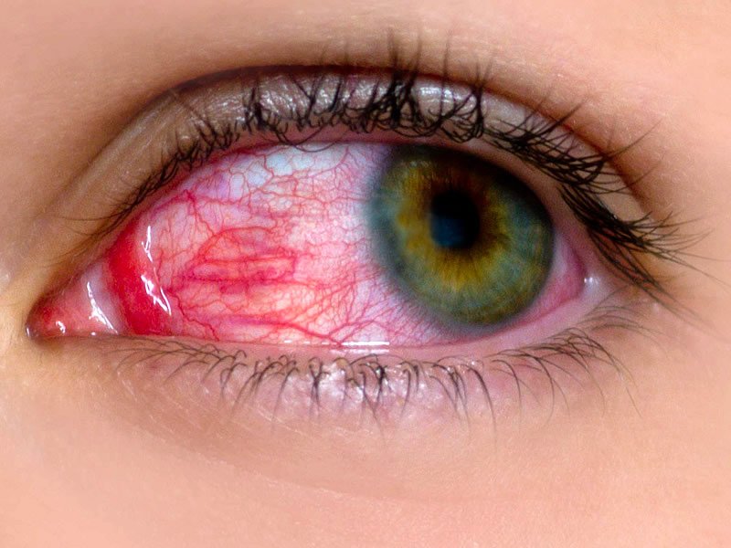 Adenovirüs Nasıl Bulaşır