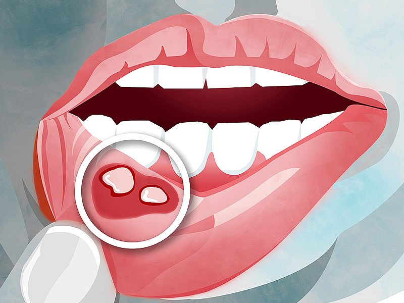 Ağız Ülserine Nedir? Belirtileri ve Nedenleri Nelerdir? Ne İyi Gelir? Ağız Ülseri Bitkisel Tedavi