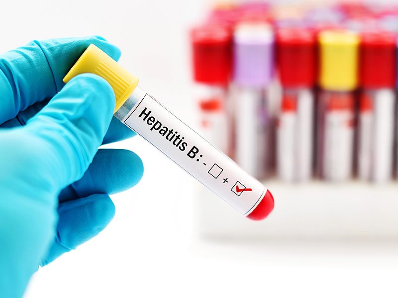 Anti Hbs Nedir? Nasıl Bulaşır? Pozitif, Negatif, Yüksek Olması Ne Demek?