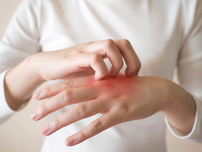 Egzamanın Belirtileri