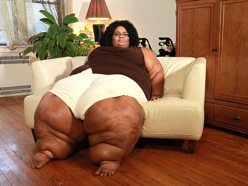 Elephantiasis Nedir? Elephantiasis Nedir?