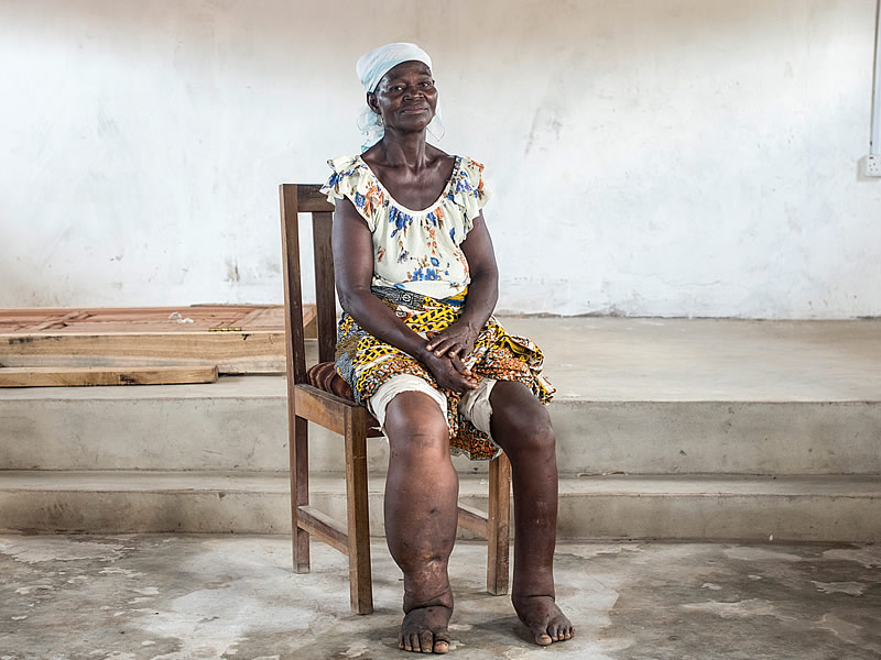 Fil Hastalığı (Elephantiasis) Nedir? Nasıl Bir Hastalıktır? Etkeni ve Tedavisi