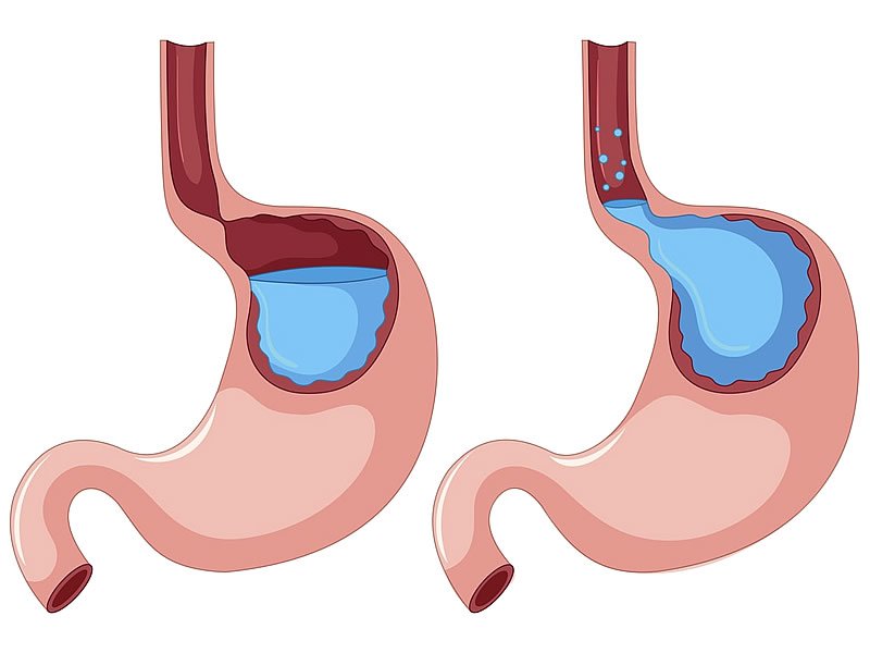 Gastrit Nedir? Belirtisi Nelerdir? Ne İyi Gelir? Neden Olur?