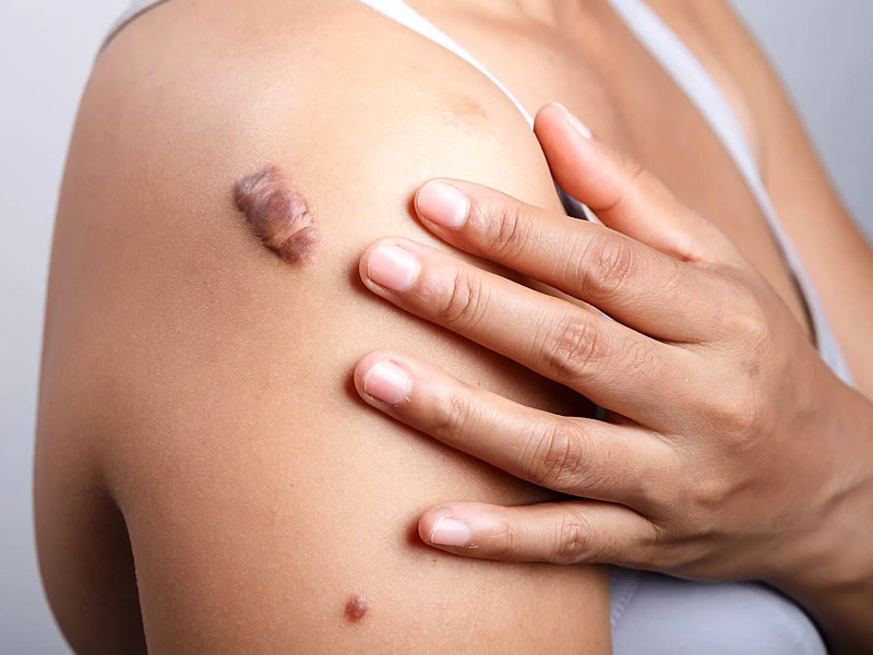 Keloid Skar Nedir? Neden Olur? Nasıl Geçer? Tedavisi Nasıl Yapılır?