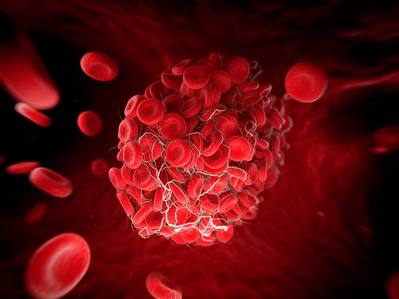 Koronas Kan Pıhtılaşması Tedavisi