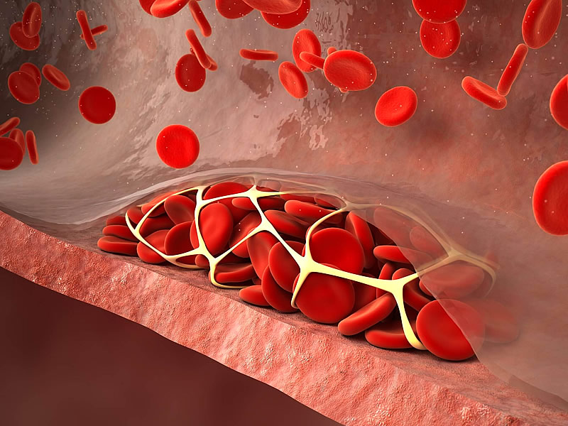 Koronavirüs Sonrası Kan Pıhtılaşması Belirtileri