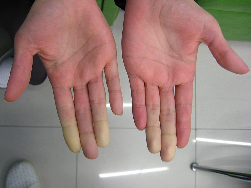 Raynaud Hastalığı Nedir Neden Olur Belirtileri Sebepleri Tedavisi 4100