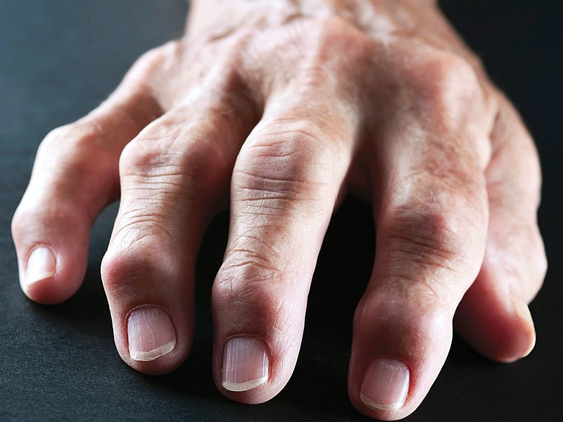 Romatoid Artrit Belirtileri Romatoid Artrit Belirtileri