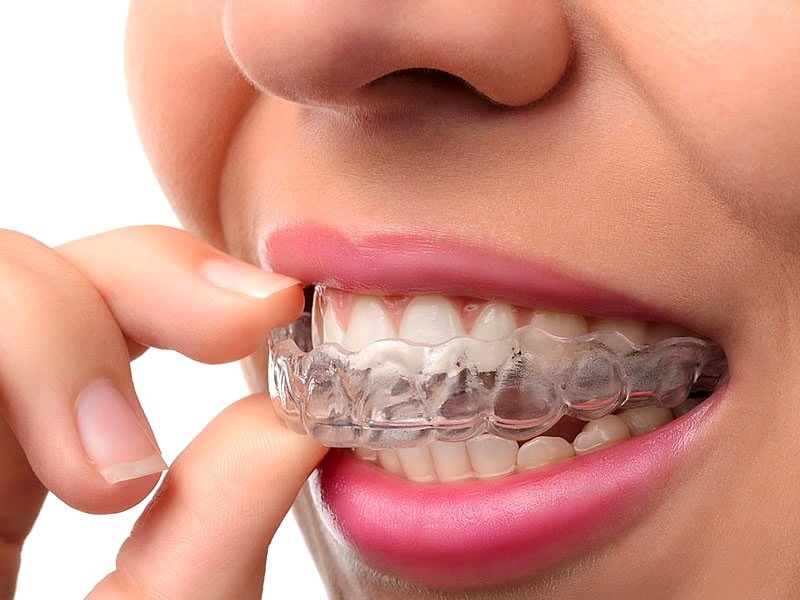 Şeffaf Aparey Nedir? Fiyatları Ne Kadar? Nerede Satılır?