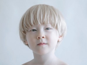 Albinizm Hastalığı Nedir? Nasıl Olur? Nedenleri ve Tedavisi