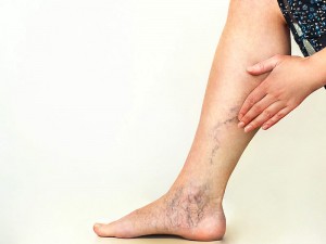 Bacak Damar Tıkanıklığı Belirtileri Nelerdir? Egzersizleri ve Bitkisel Tedavisi