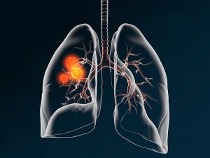 Küçük Hücreli Akciğer Kanseri Nedir? Belirtileri Nelerdir? Yaşam Süresi Ne Kadar?