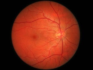 Retina Yırtılma Belirtileri Nelerdir? Nasıl Olur? Sebebi Nedir? Nasıl Tedavi Edilir?