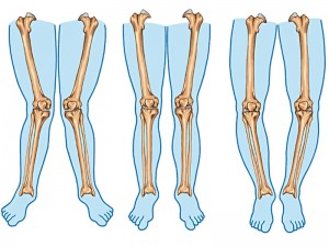 X Bacak Deformitesi Nedir? Nasıl Olur? X Bacak Düzeltme Bandı ve Ameliyatı