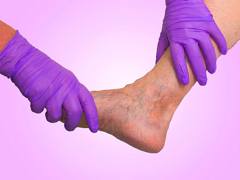 Toplardamar Yetmezliği Nedir? Belirtileri Nelerdir? Ameliyatı ve Bitkisel Tedavisi